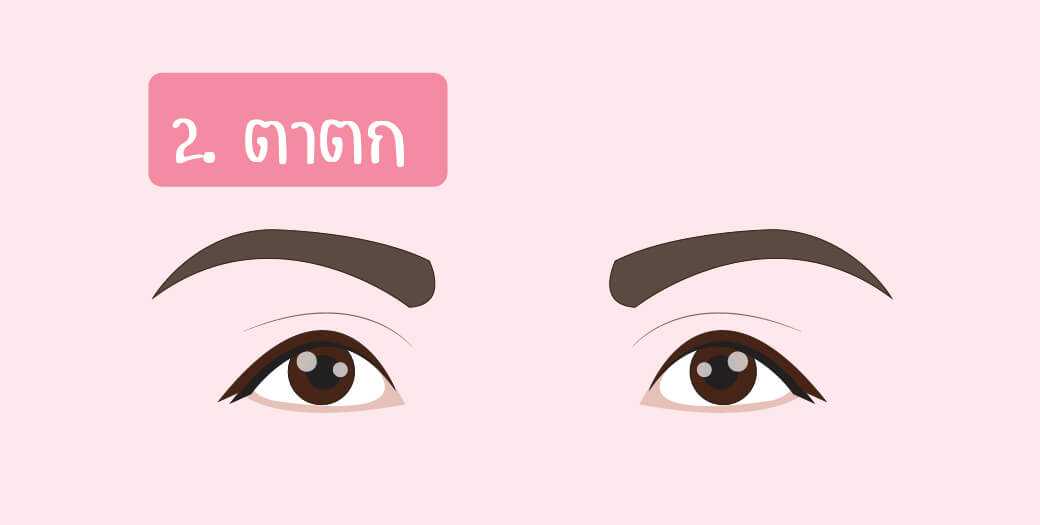 ตาตก (หางตาคล้อยต่ำกว่าหัวตา)